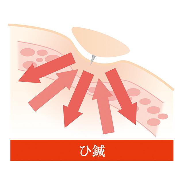 ひ鍼 90針 鍼 治療器 ひ針 ツボ ひしん 皮内針 日本薬興 鍼治療用具 針 使い捨て 肩こり 腰痛 四十肩 五十肩 股関節痛 ひざの痛み｜heartdrop｜03
