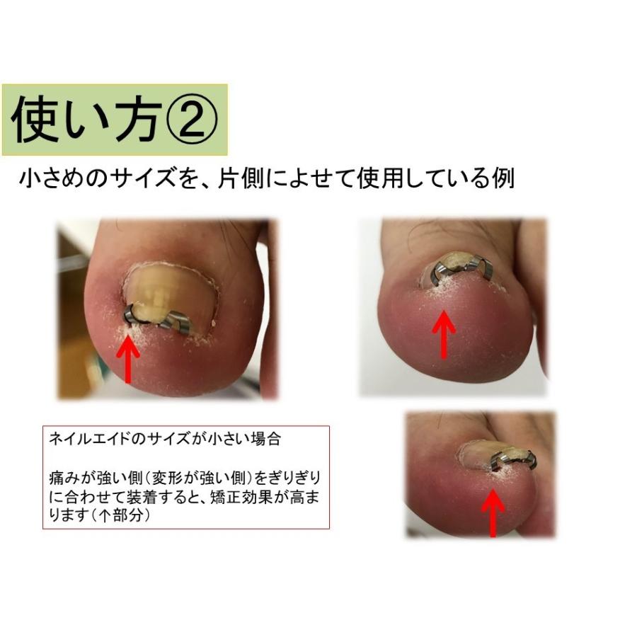 巻き 爪 矯正