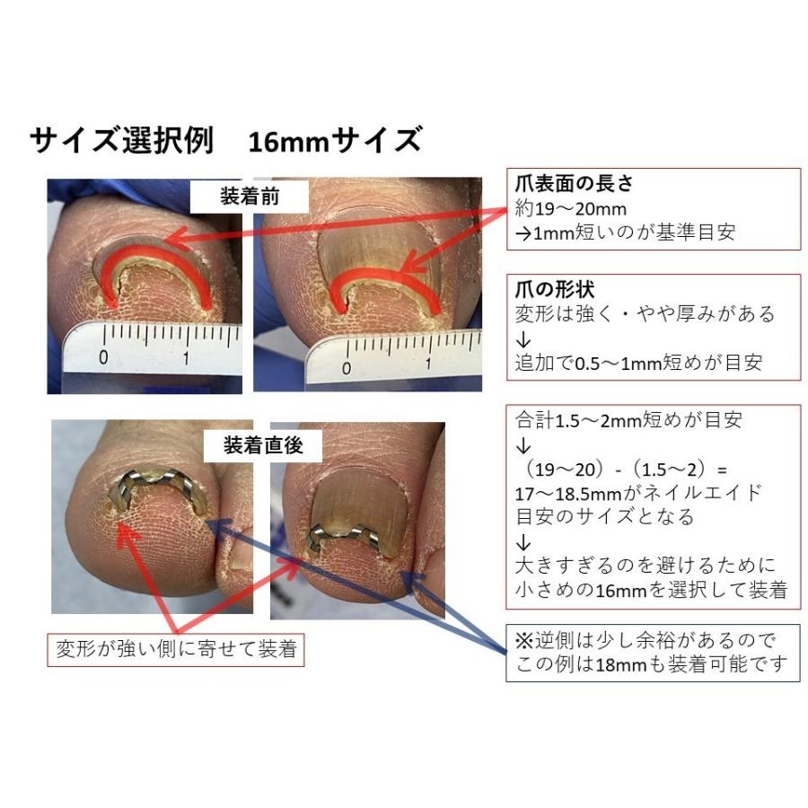 巻き爪治療 巻き爪矯正 自分で　　ネイルエイド １６ｍｍ　　ワイヤー クリップ 切り方 リフト 市販 グッズ｜himawari-corp｜17