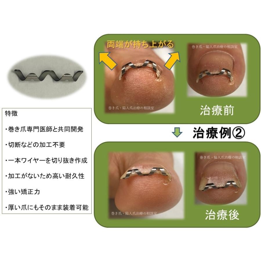 巻き爪治療 巻き爪矯正 自分で ネイルエイド 16mm ワイヤー クリップ 切り方 リフト 市販|himawari-corp|07