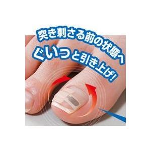 巻き爪シール 1ヶ月ケア 巻き爪対策 公式通販 新入荷　流行 巻き爪 対策 シール お悩み 足 シール型 彎曲爪 ツメ 巻爪 巻きつめ 矯正 まきづめ まきつめ