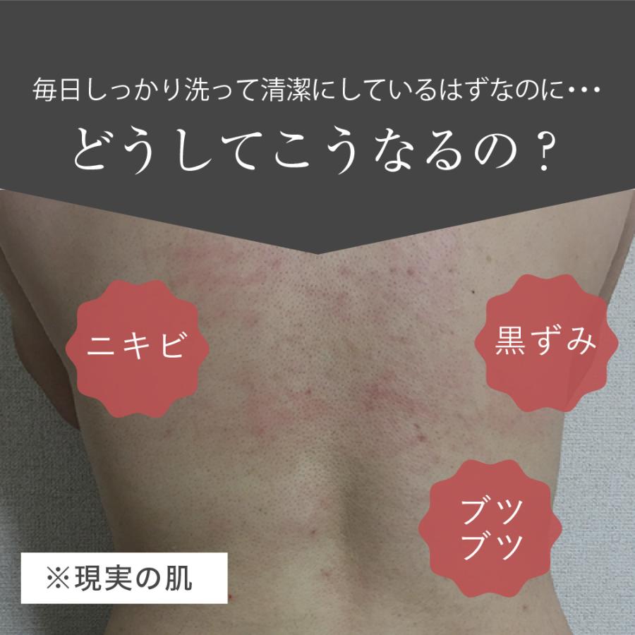 医薬部外品 Jitte+ ジッテプラス 3個セット ジェル ニキビケア
