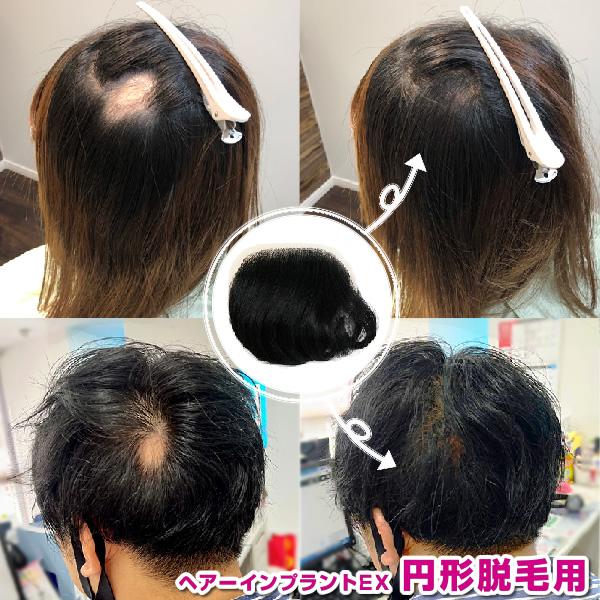 部分ウィッグ　頭皮一体増毛 ヘアーインプラントEX　円形脱毛用　※装着にはテープかシリコンが必要です｜increasehair｜04