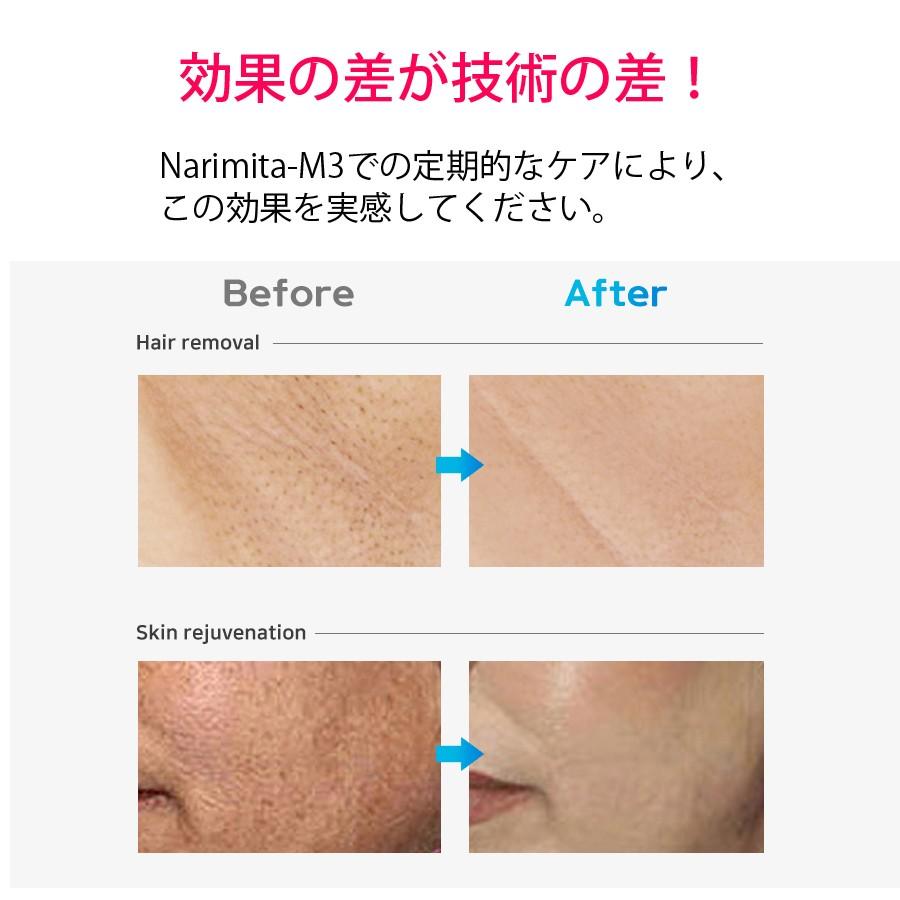IPL光美容器 Narimita-M3の画像