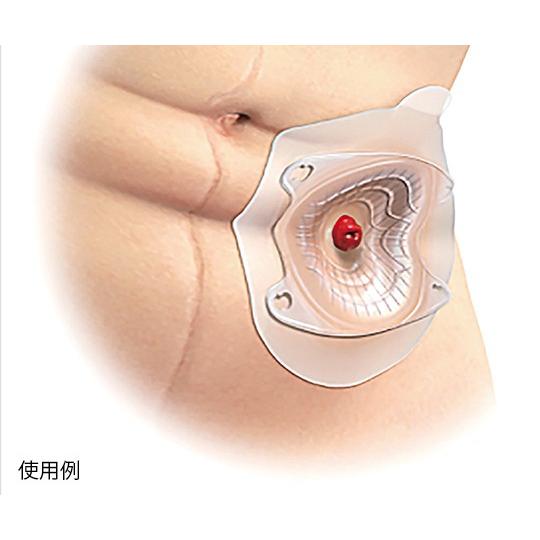 コロプラスト センシュラ ミオ1 ウロ ライト 単品系装具