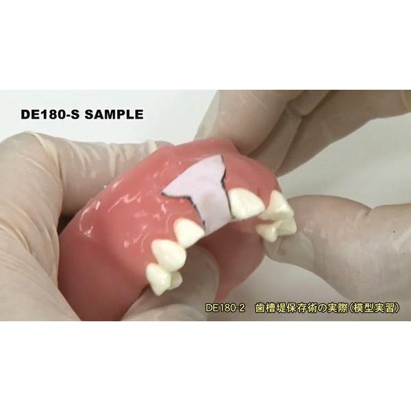 臨床応用できる歯槽堤保存術入門 歯科 DE180-S 全2巻 | ジャパンライム | 03