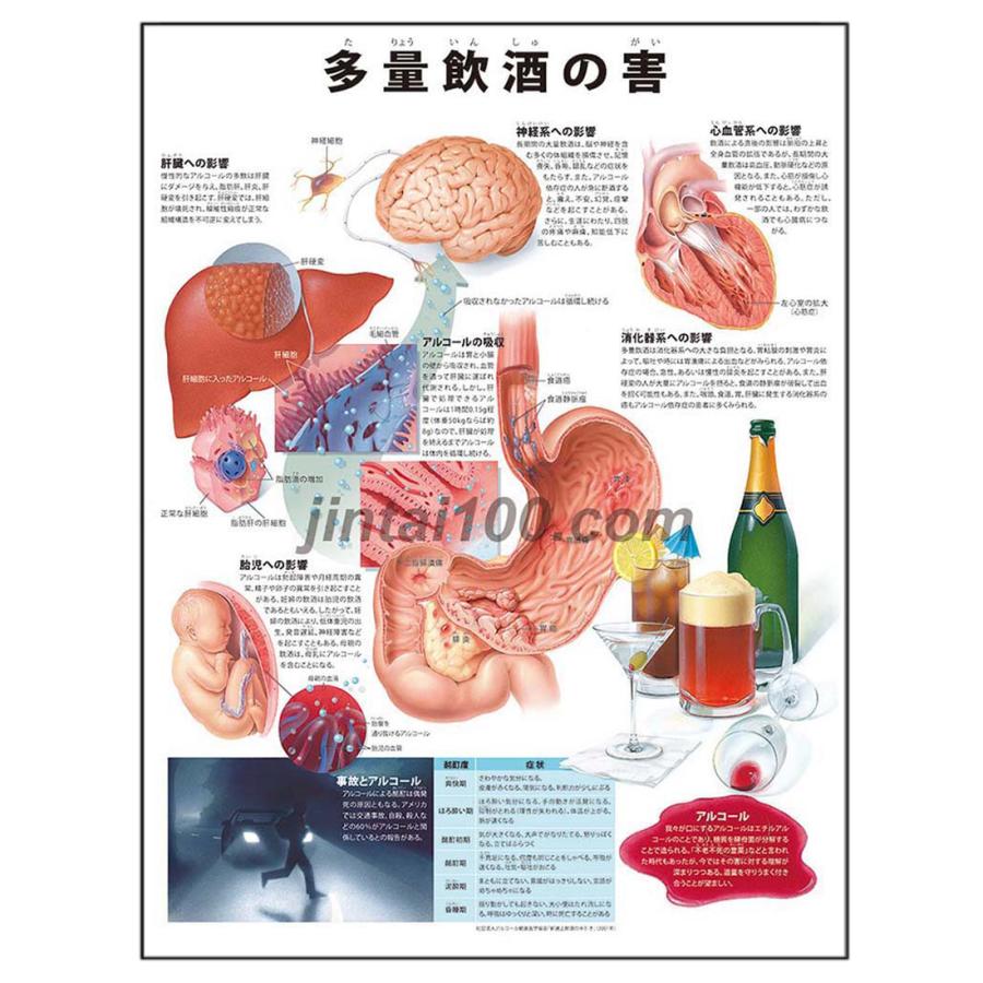 多量飲酒の害 J9696p 人体図 医学ポスター 世界一流のメディカルイラスト J9696p 人体百科 通販 Yahoo ショッピング
