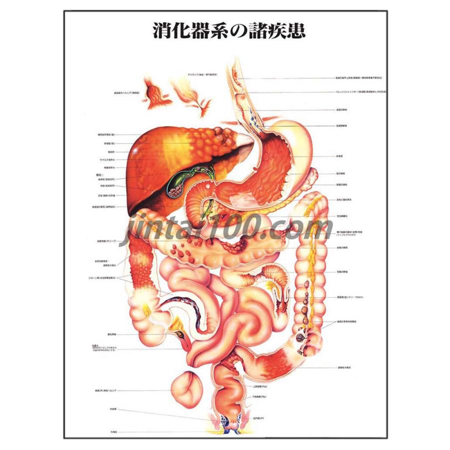 消化器系の諸疾患」医学ポスター ポスターB2サイズ 人体解剖学図 消化器系の諸疾患」医学ポスター ポスターB2サイズ 人体解剖学図