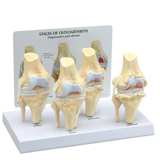 医学模型 変形性膝関節症/4段階 日本語訳付き GPI Anatomicals : 人体