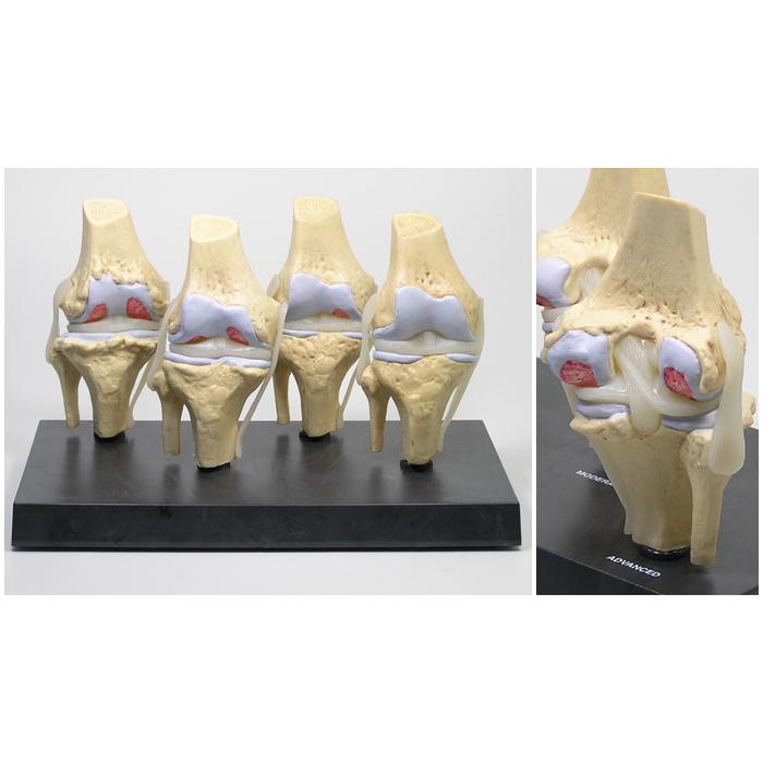 医学模型 変形性膝関節症/4段階 日本語訳付き GPI Anatomicals : 人体