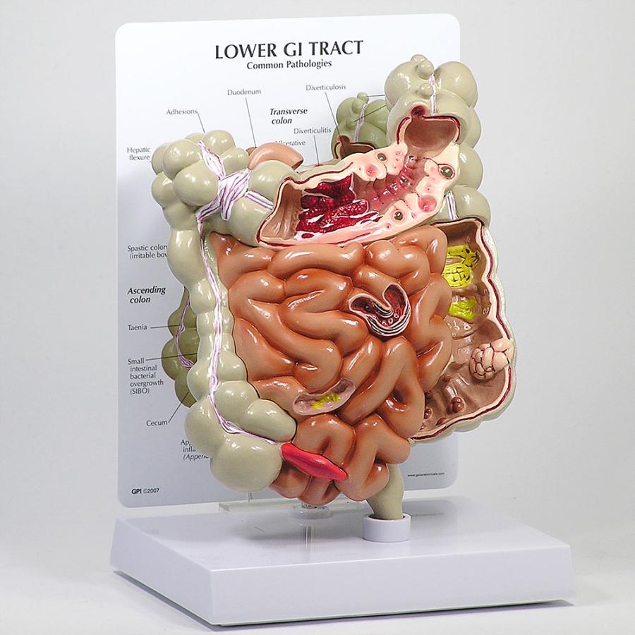 医学模型 大腸・小腸の諸疾患 日本語訳付き GPI Anatomicals : 人体