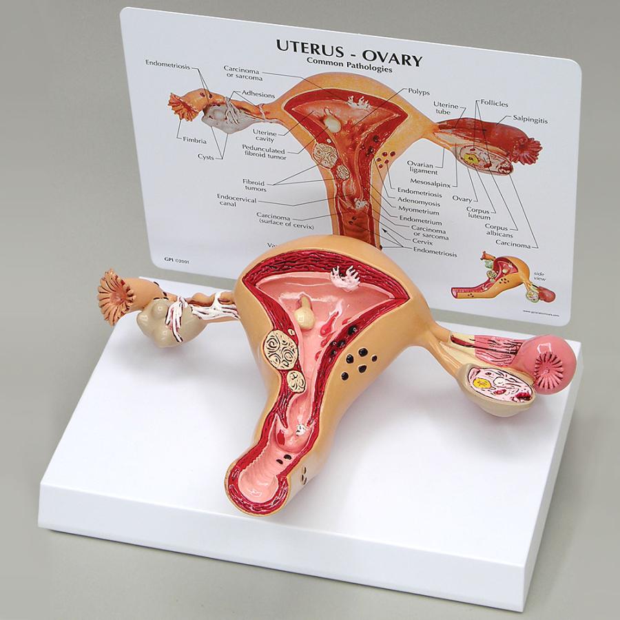 医療用、模型。子宮 医学模型 子宮と卵巣の諸疾患 日本語訳付き GPI Anatomicals : 人体