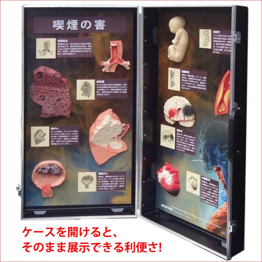 「 喫煙の害」立体模型ディスプレイ 禁煙指導 タバコの危害 啓蒙教材