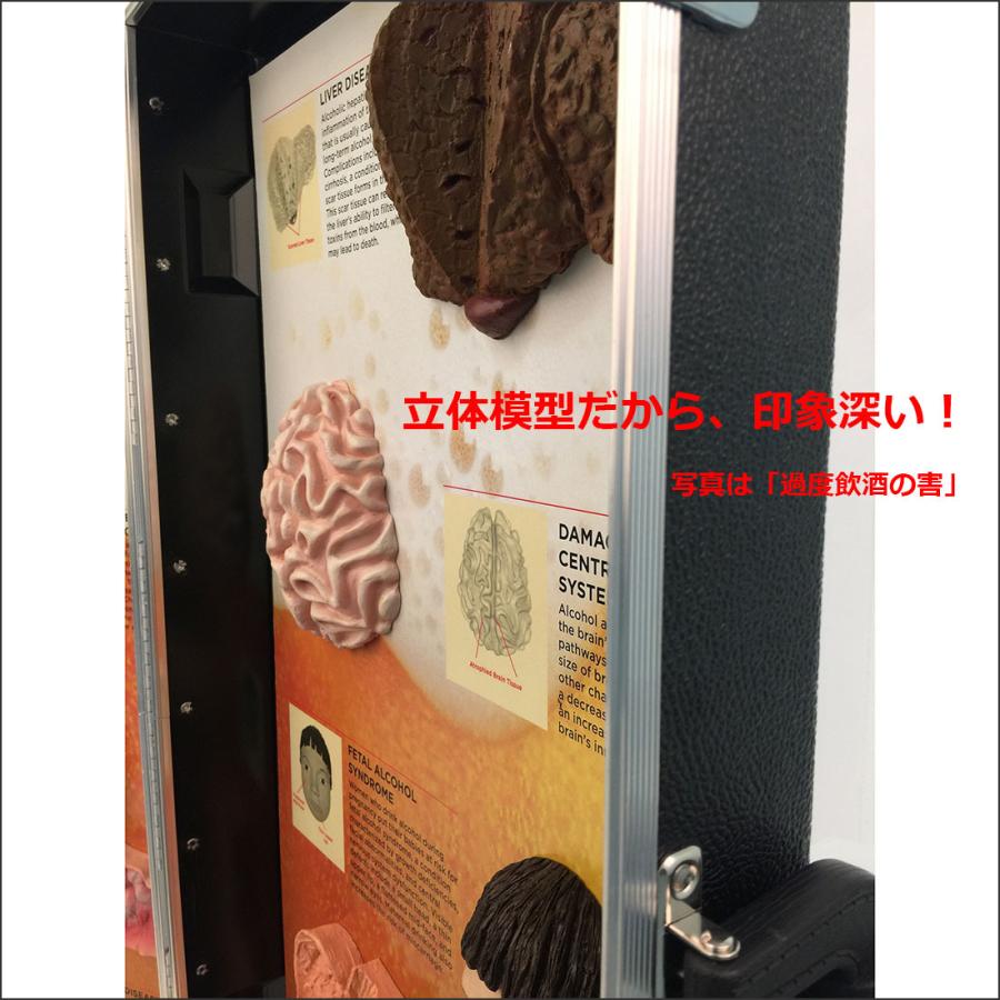 お買い得！ 「 喫煙の害」立体模型ディスプレイ 禁煙指導 タバコの危害 啓蒙教材 【TMF1938736976】(68750円)