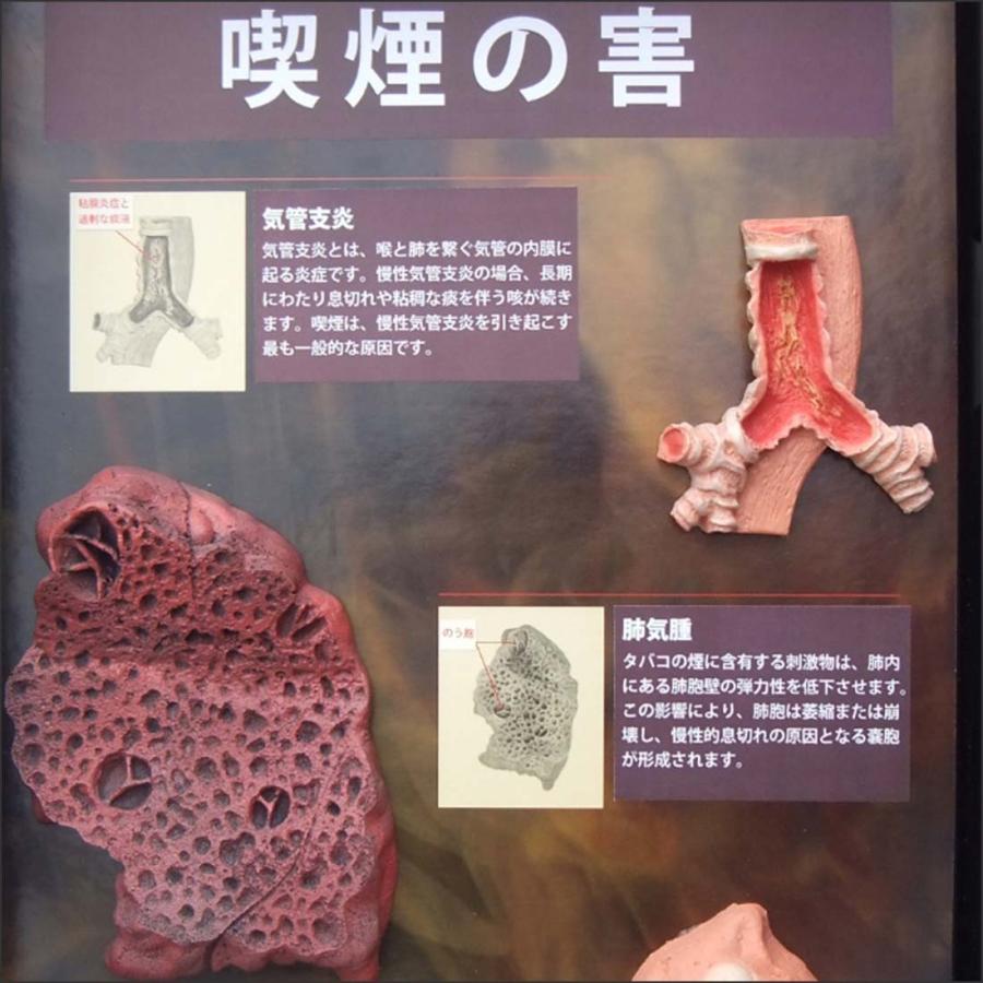 お買い得！ 「 喫煙の害」立体模型ディスプレイ 禁煙指導 タバコの危害 啓蒙教材 【TMF1938736976】(68750円)