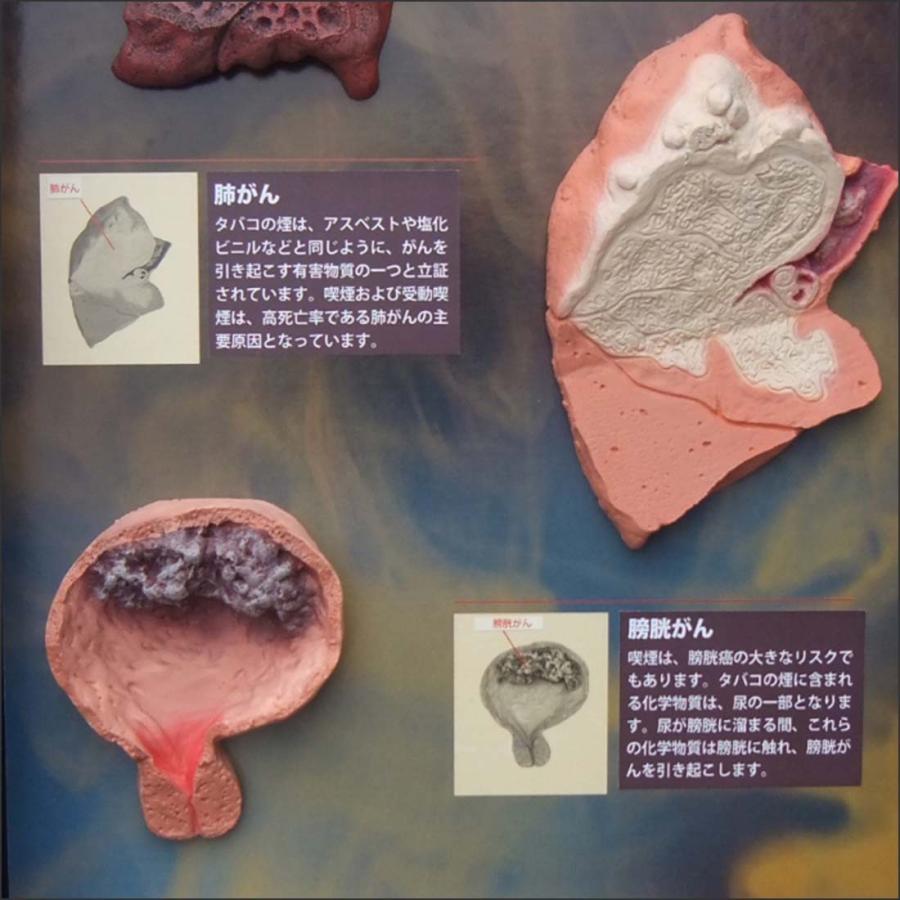 お買い得！ 「 喫煙の害」立体模型ディスプレイ 禁煙指導 タバコの危害 啓蒙教材 【TMF1938736976】(68750円)