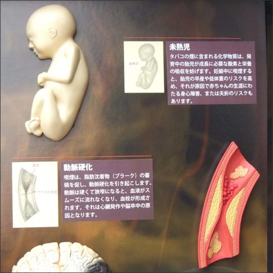 お買い得！ 「 喫煙の害」立体模型ディスプレイ 禁煙指導 タバコの危害 啓蒙教材 【TMF1938736976】(68750円)
