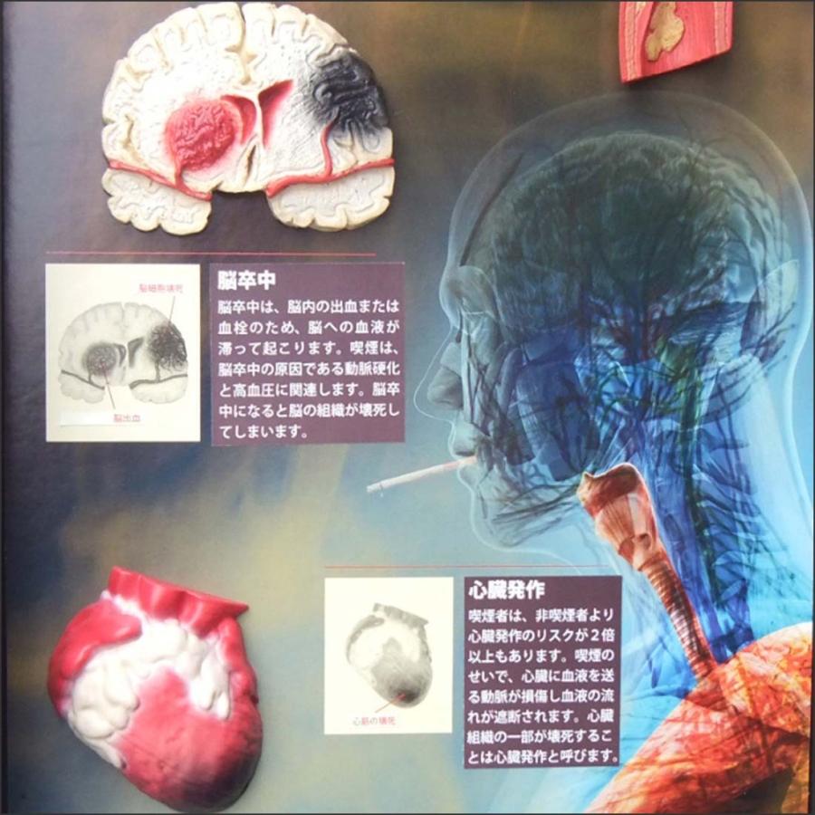 お買い得！ 「 喫煙の害」立体模型ディスプレイ 禁煙指導 タバコの危害 啓蒙教材 【TMF1938736976】(68750円)