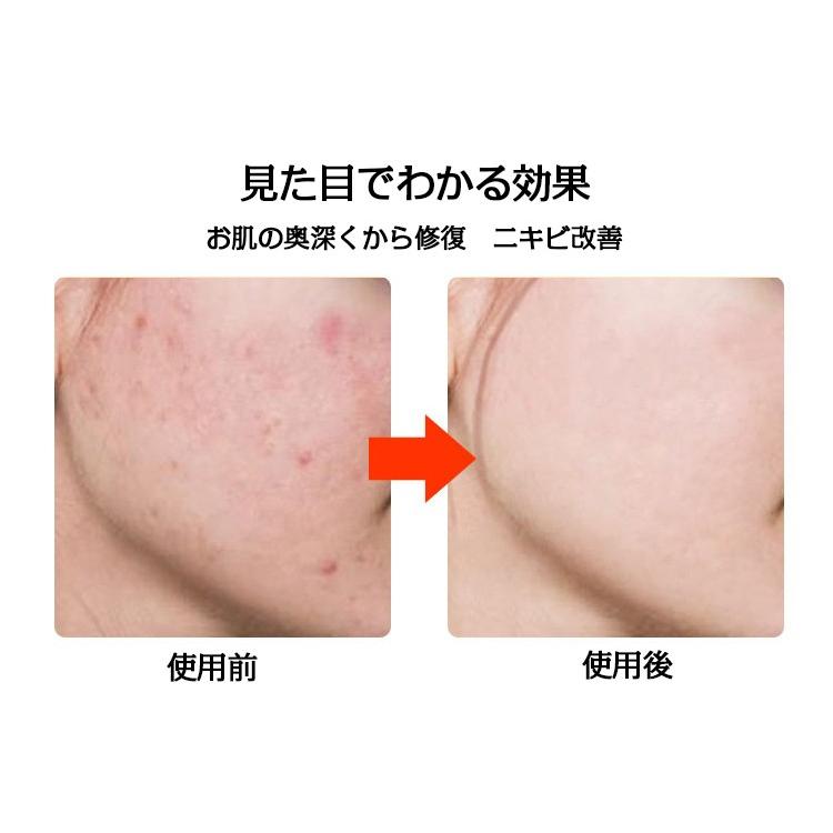 超音波 美顔器 イオン導入 ミニ フィスケア 超音波美顔器 ニキビ 毛穴