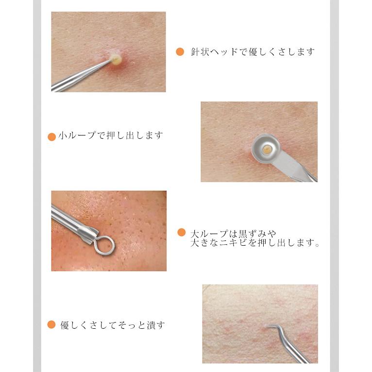 黒ニキビ 角栓: ニキビ 芯 埋まってる 取り方 | 「毛穴の黒ずみ（角栓）」の原因・症状、予防法を解説 – UGKHX