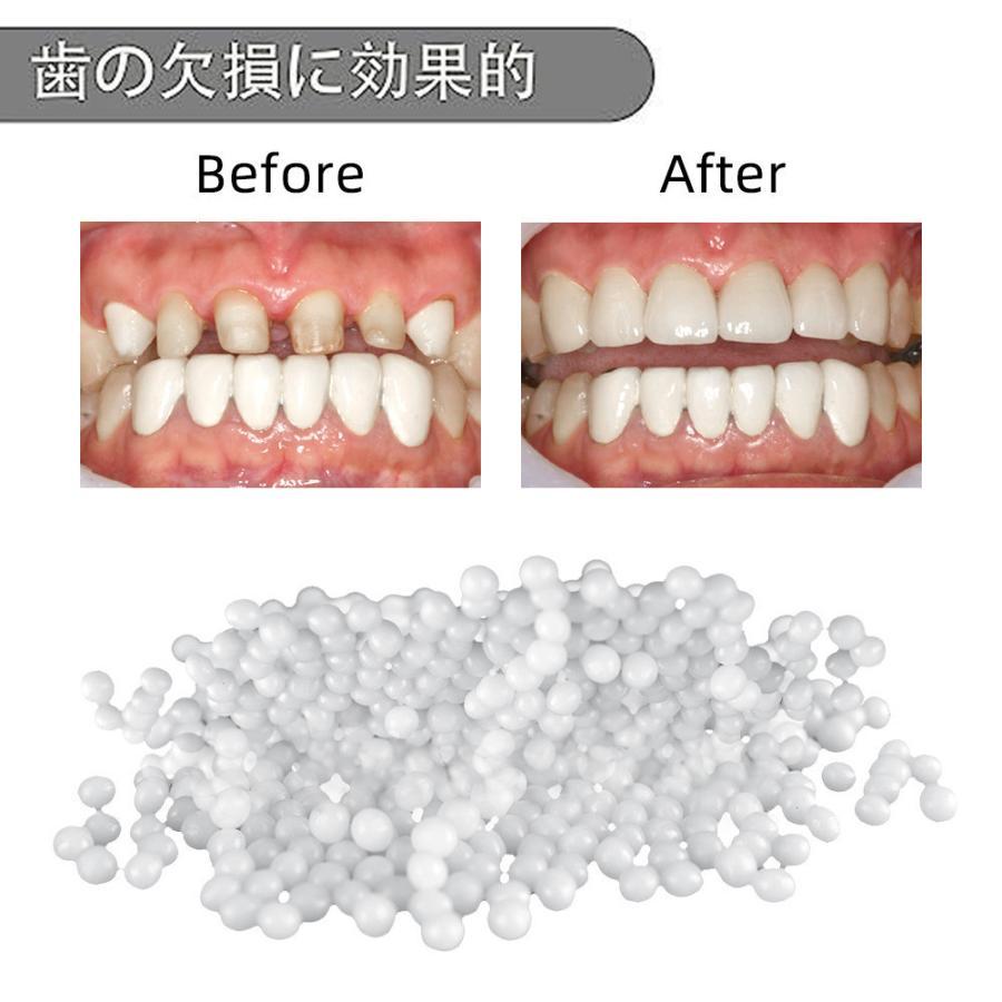 入れ歯、歯の固体ゲルの一時修復キット、可塑熱合ビーズの歯粒接着剤