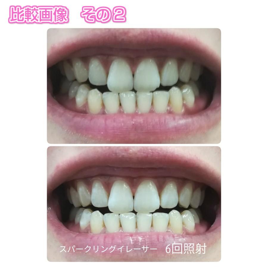 ホワイトニング スパークリングイレーサー ジェル ホワイト