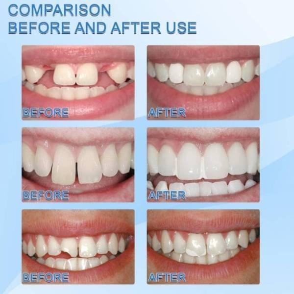 歯の修復ツール 一時的 入れ歯 成形可能 固形接着剤 仮歯 義歯 隙間入れ 樹脂ビーズ｜keigo-st｜06