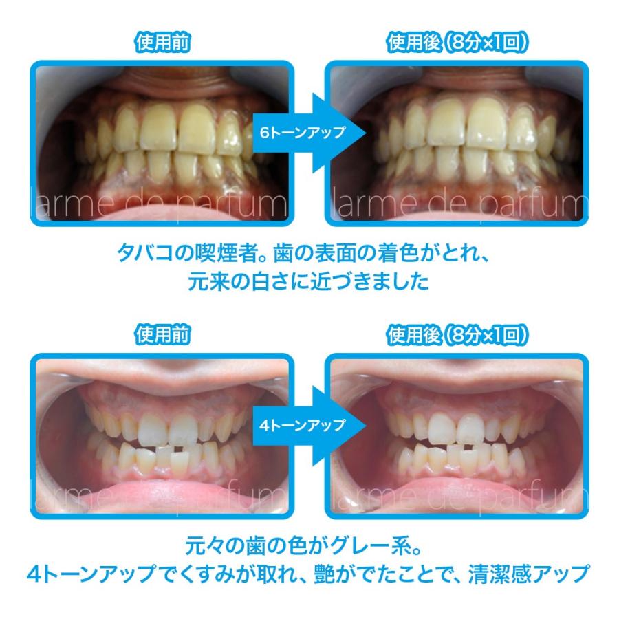 ホワイトニング 自宅 の 歯