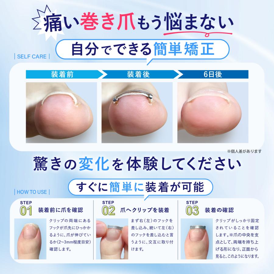 巻き爪クリップ 陥入爪 まきずめ まきづめ 巻爪 まきつめ 巻き爪矯正 Dr nail ドクターネイル Mサイズ 2個セット |  | 01