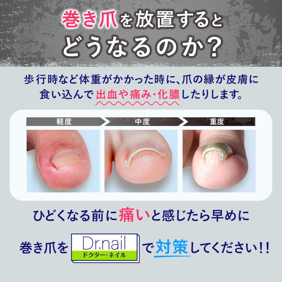 巻き爪クリップ 陥入爪 まきずめ まきづめ 巻爪 まきつめ 巻き爪矯正 Dr nail ドクターネイル Mサイズ 2個セット |  | 03