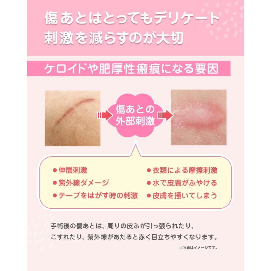 傷あとケアシリコーンシート ケロイド 傷あとケア用シリコンジェルシート 手術後 帝王切開 |  | 02
