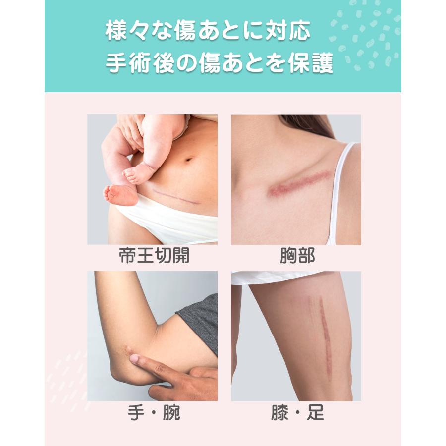 傷あとケアシリコーンシート ケロイド 傷あとケア用シリコンジェルシート 手術後 帝王切開 3本セット |  | 06