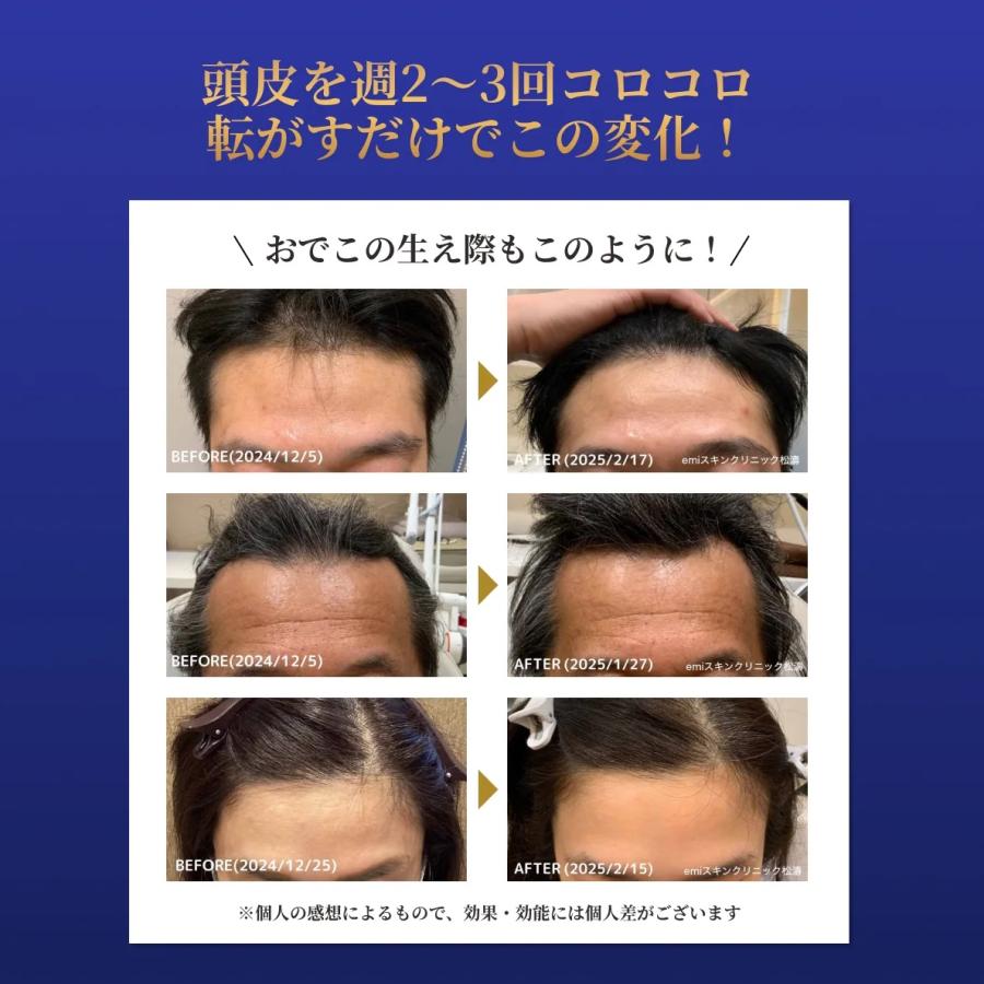 Dermaroller（ダーマローラー） hc902 育毛 頭皮活性化 ヘアローション