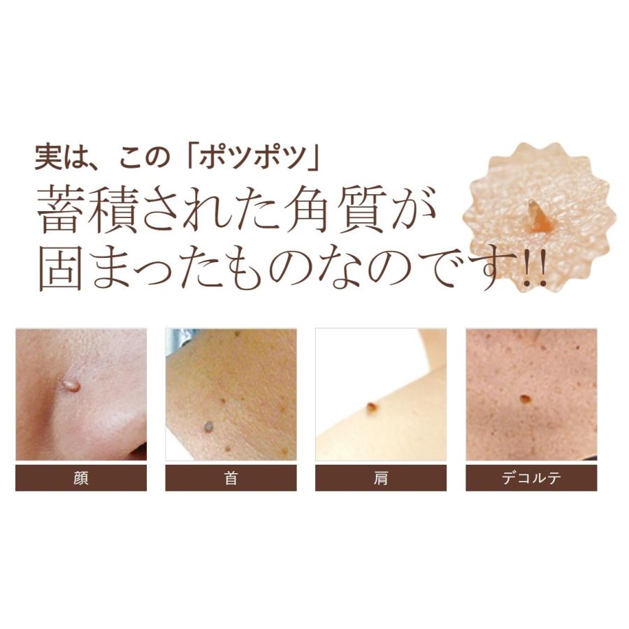 イポケア イボ 除去 イボ取り イボ取り (１０本セット) お肌 皮膚 首 ポツポツ 美容液 角質取り 首イボ はとむぎ いぼ 自分で 角質 イポケアEX 18ml_1