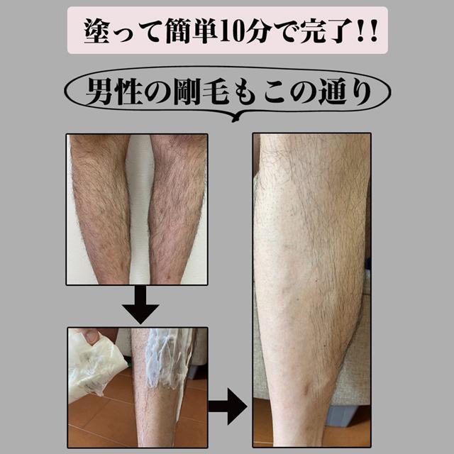 除毛 除毛クリーム 美肌 シルクロエ セルフリムーバー VIOライン除毛