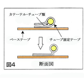 ALCARE アルケア クイックフィックス 3号（36Fr以下 カテーテル