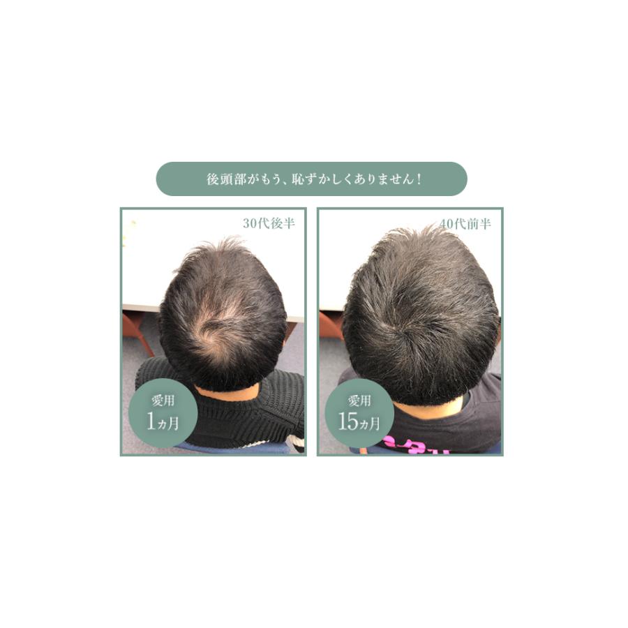 薄毛 白髪 対策 薬用 育毛剤 GROXIL ヘアトニック サプリ 医薬部外品