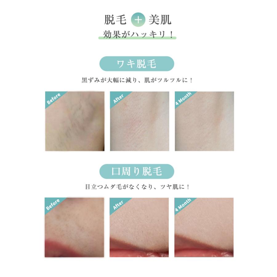 冷感脱毛器+スキンケア+ニキビ Amazon | SkinRevolve 家庭用 光美容器 だつもうき メンズ レディース