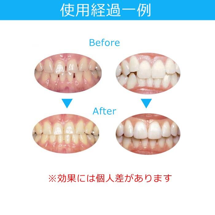 方 治し 自分 噛み 歯 合わせ で の