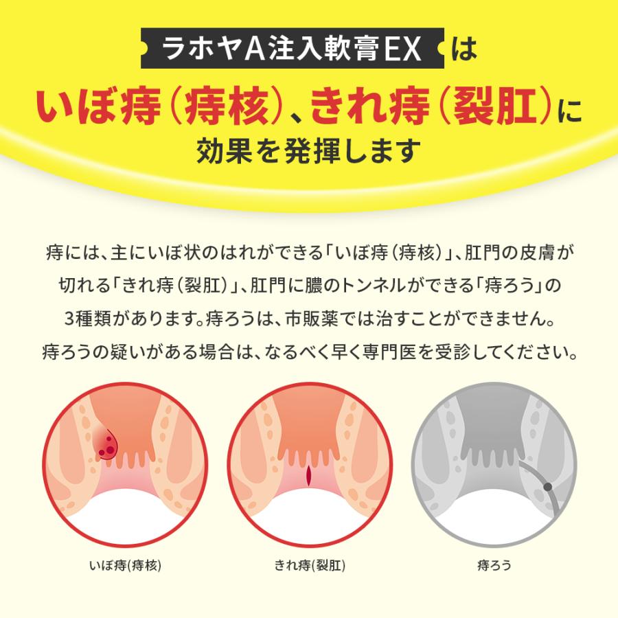 切れ痔薬塗り方 – 切れ痔 注入軟膏 : 痔の薬の使い方 – APTR