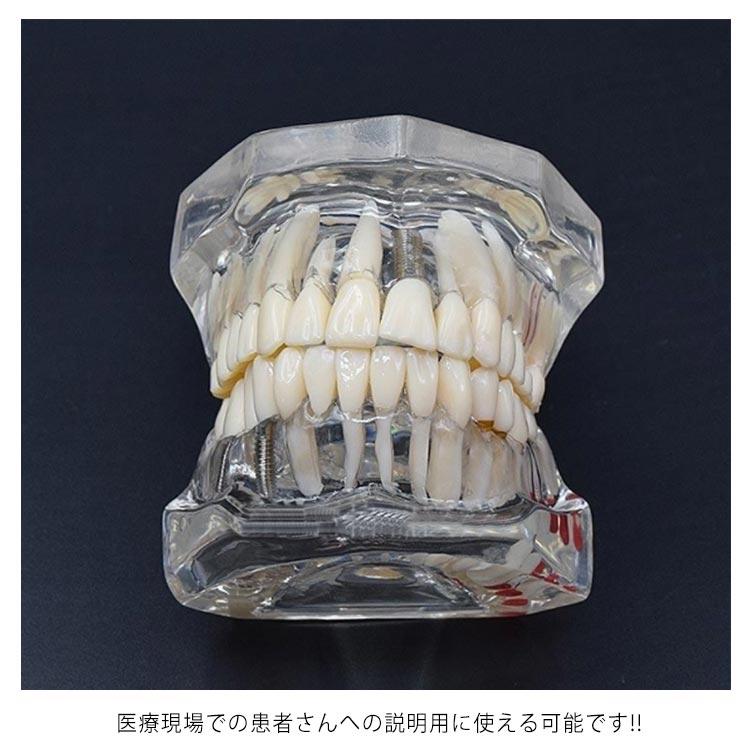歯模型 透明 歯の模型 歯列模型 疾患展示模型 歯科模型 差し歯 歯医者 人体解剖モデル 歯 模型 歯 モデル 開閉式 歯科 口腔内模型 クリニック｜minoaka｜11