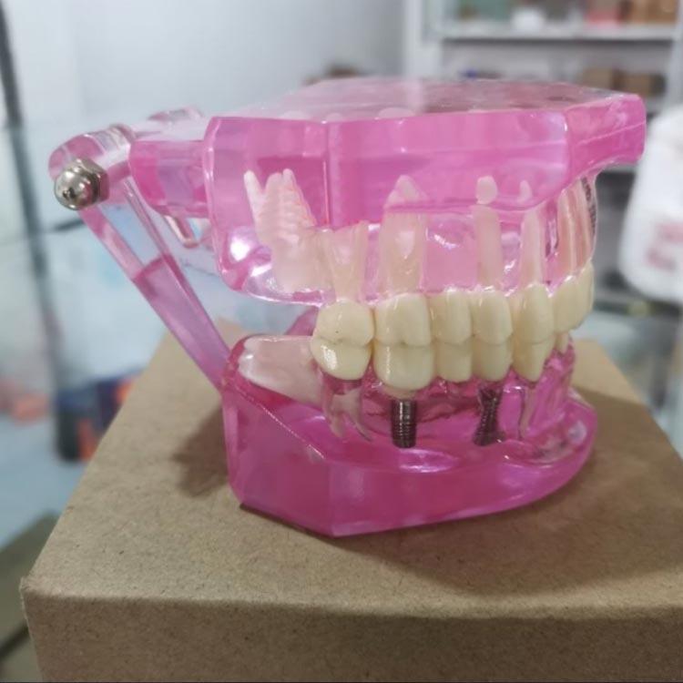 歯模型 透明 歯の模型 歯列模型 疾患展示模型 歯科模型 差し歯 歯医者 人体解剖モデル 歯 模型 歯 モデル 開閉式 歯科 口腔内模型 クリニック｜minoaka｜05