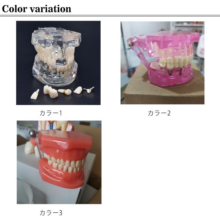 歯模型 透明 歯の模型 歯列模型 疾患展示模型 歯科模型 差し歯 歯医者 人体解剖モデル 歯 模型 歯 モデル 開閉式 歯科 口腔内模型 クリニック｜minoaka｜07
