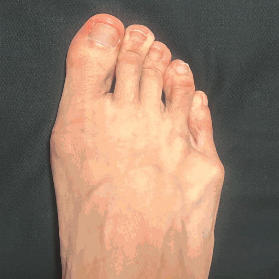 【片足用・左右兼用】【ハードタイプ】 外反母趾 内反小趾 サポーター 足指 広げる 矯正  矯正グッズ 矯正サポーター  外反母趾おやすみサポーター |  | 05