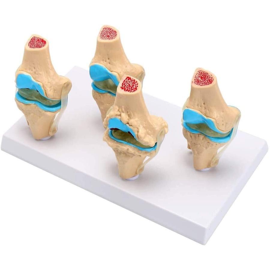 人間の骨格膝関節解剖学モデル医学教育用品骨粗鬆症病的状態モデル1セット取り外し可能｜mya-bussan｜03