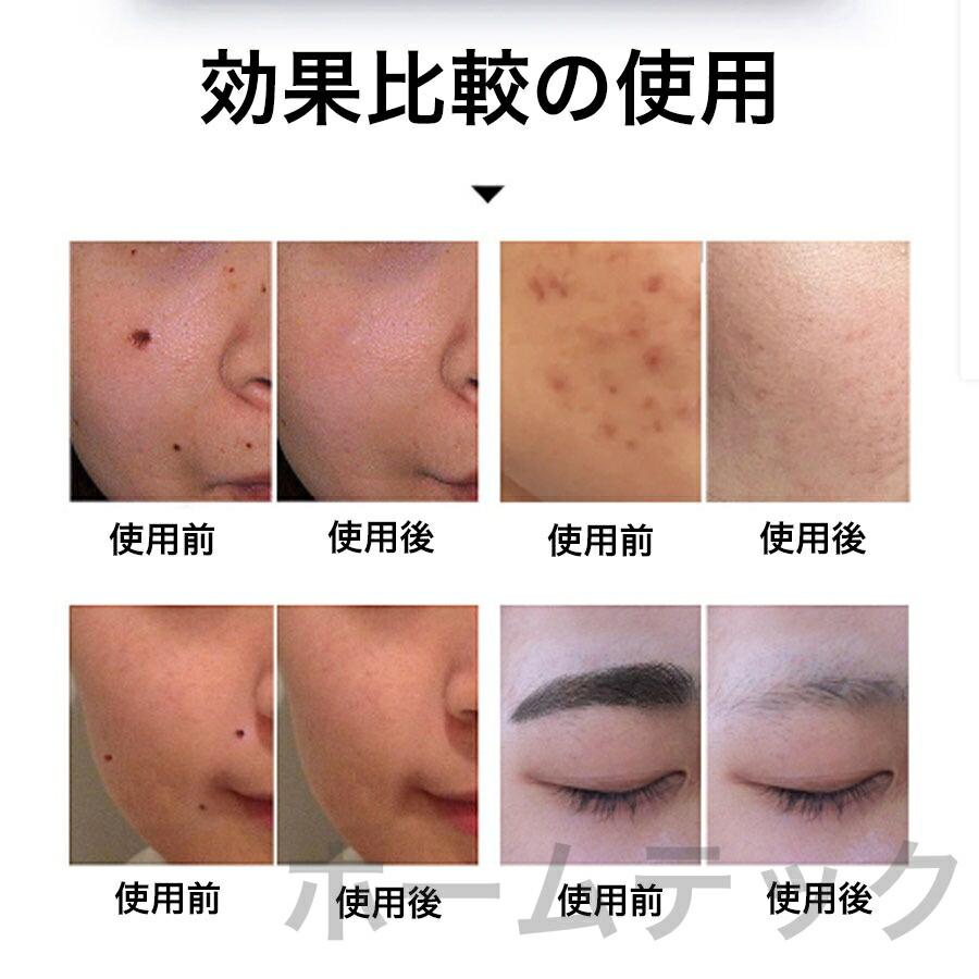 ピコレーザー 美顔器 美容機器 自宅 家庭用 レーザーペン シミ取り