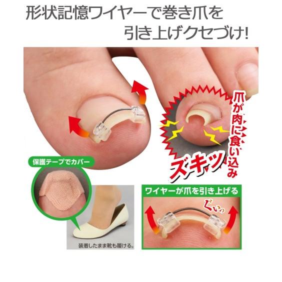 一般医療機器 巻き爪ワイヤーガード ボディケア ラッピング無料 nissen ニッセン 日本の職人技