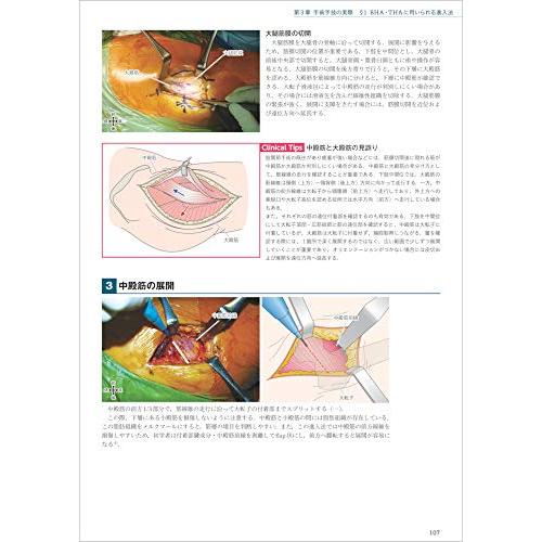 BHA・THA 人工股関節置換術パーフェクト?人工骨頭置換術・人工股関節全置換術の基本とコツ BHA THA 手術までの準備 術前計画