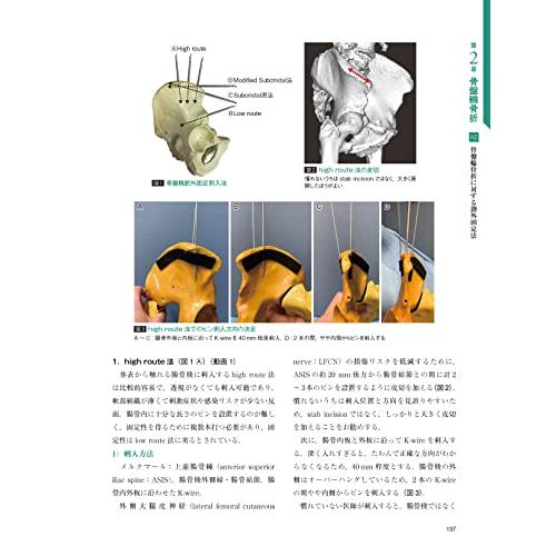【裁断済】骨盤骨折　寛骨臼骨折・骨盤輪骨折の手術手技 骨盤骨折: 寛骨臼骨折・骨盤輪骨折の手術手技 (整形外科SURGICAL