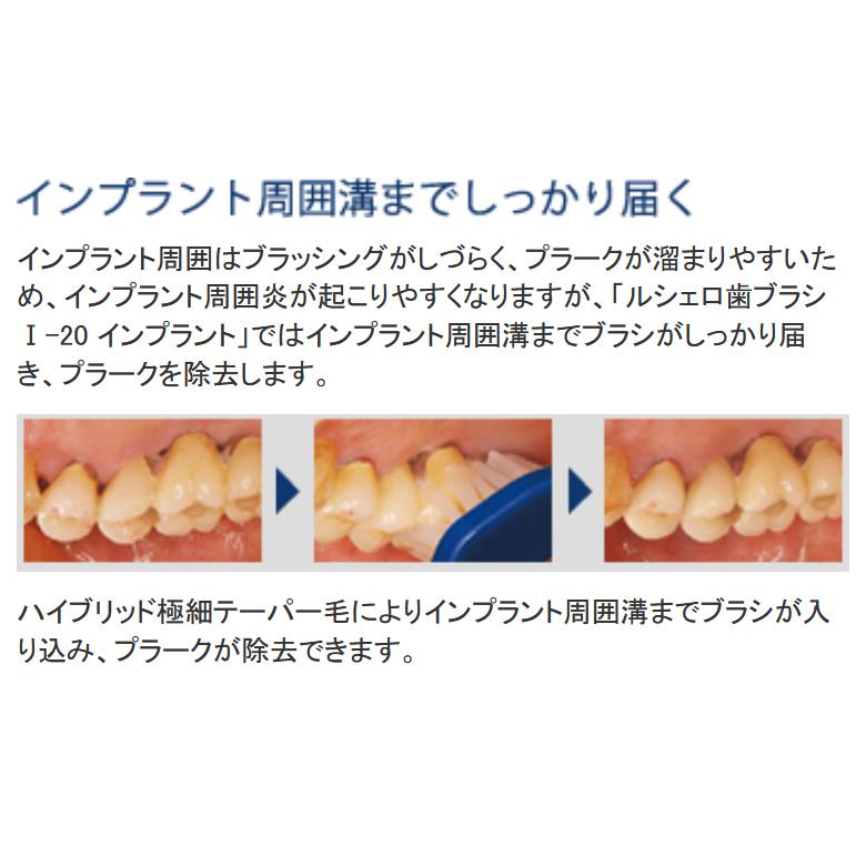 GC インプラント専用歯ブラシ ruscello ジーシー インプラント周囲粘膜炎予防 周囲炎の進行予防 ルシェロ I-20 ハブラシ 5本 大量購入割引あり｜okuchinomente｜07